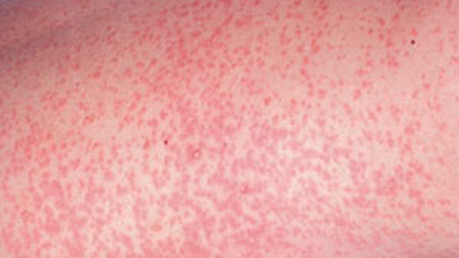 South East's 742 Rubella Record Calls For Action 1 Rubella Virus