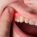 How Gum Disease Could Be Putting Your Heart At Risk 5 How Gum Disease Could Be Putting Your Heart At Risk
