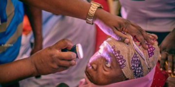 Federal Govt Targets 25,000 Nigerians For Free Cataract Surgery 4 Bauchi Commissioner Offers Free Eye Medical Outreach