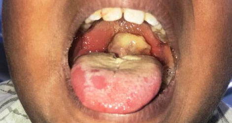 Diphtheria patient 515x290 1