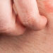 Jock Itch: Causes, Symptoms, Prevention Tips 5 Jock Itch: Causes, Symptoms, Prevention Tips