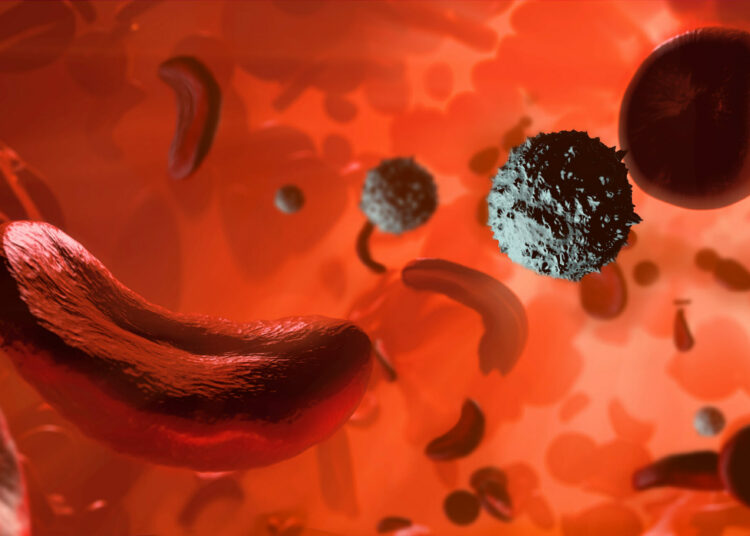 Sickle Cell Realities