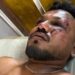‘I Don’t Believe How I Survived’, Sole Survivor Of Air India Crash Speaks From Hospital Bed 5 ‘I Don’t Believe How I Survived’, Sole Survivor Of Air India Crash Speaks From Hospital Bed