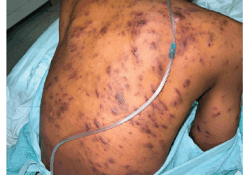 Kaposi Sarcoma: When Immunity Falters, Cancer Strikes