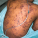 Kaposi Sarcoma: When Immunity Falters, Cancer Strikes 5 Kaposi Sarcoma: When Immunity Falters, Cancer Strikes