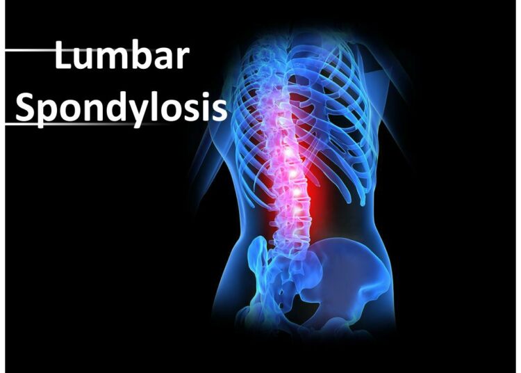Lumbar Spondylosis