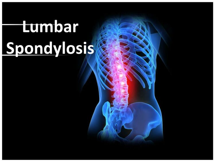 Lumbar Spondylosis