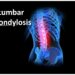 Understanding Lumbar Spondylosis: What Your Lower Back Is Telling You 5 Understanding Lumbar Spondylosis: What Your Lower Back Is Telling You