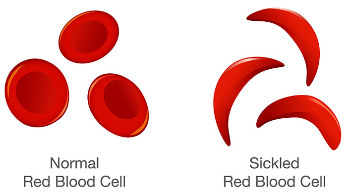 Sickle Cell And The Price Of Ignorance 1 The difference of Normal red blood cell and sickle cell. Illustration about medical.