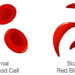 Sickle Cell And The Price Of Ignorance