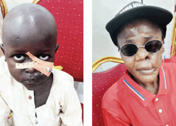 Beyond The Scars: Sokoto’s Unending Fight Against Flesh-eating NOMA Disease