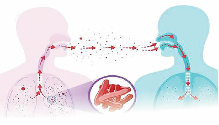 Stakeholders Demand ₦1bn Yearly For TB Amid 70% Funding Gap 1 TUBERCULOSIS