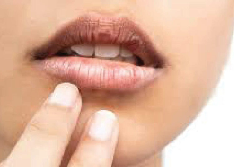 dry mouth