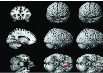 Unraveling Margaria-Kalman Syndrome: A Rare Neurological Disorder