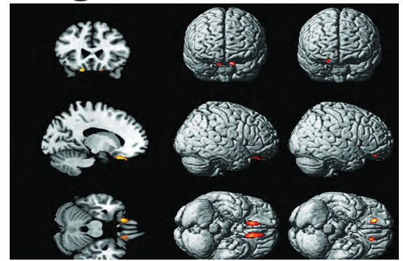 Unraveling Margaria-Kalman Syndrome: A Rare Neurological Disorder 1 kalman syndrome