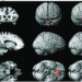 Unraveling Margaria-Kalman Syndrome: A Rare Neurological Disorder 5 Unraveling Margaria-Kalman Syndrome: A Rare Neurological Disorder