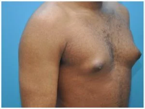 Male Breast Enlargement: An Overlooked Symptom Of Liver Disease