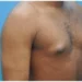 Male Breast Enlargement: An Overlooked Symptom Of Liver Disease 5 Male Breast Enlargement: An Overlooked Symptom Of Liver Disease