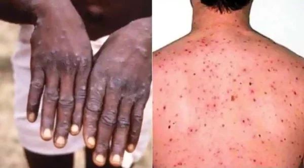 Ondo Gov't Confirms 12 Mpox Cases 1 Monkeypox 600x331 1