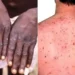 Ondo Gov't Confirms 12 Mpox Cases 5 Ondo Gov’t Confirms 12 Mpox Cases
