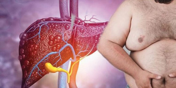 Liver Disease
