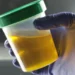 Why Drinking Urine Is A Risky Health Trend