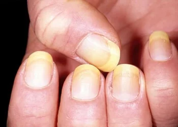 5 Nail Changes That Signal Big Health Problems