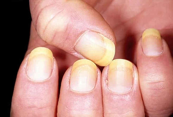 5 Nail Changes That Signal Big Health Problems 1 nails