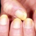 5 Nail Changes That Signal Big Health Problems