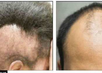 Hair Loss: The Hidden Health Warning Nigerians Often Miss
