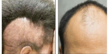 Hair Loss: The Hidden Health Warning Nigerians Often Miss