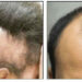 Hair Loss: The Hidden Health Warning Nigerians Often Miss