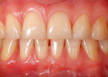 Natural Remedies For Fresh Breath And Healthy Gums