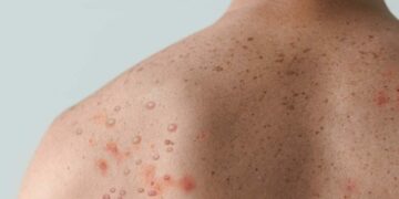 nigeria Orientation Agency Cautions Residents As Monkey Pox Hits 15 Akwa Ibom Councils