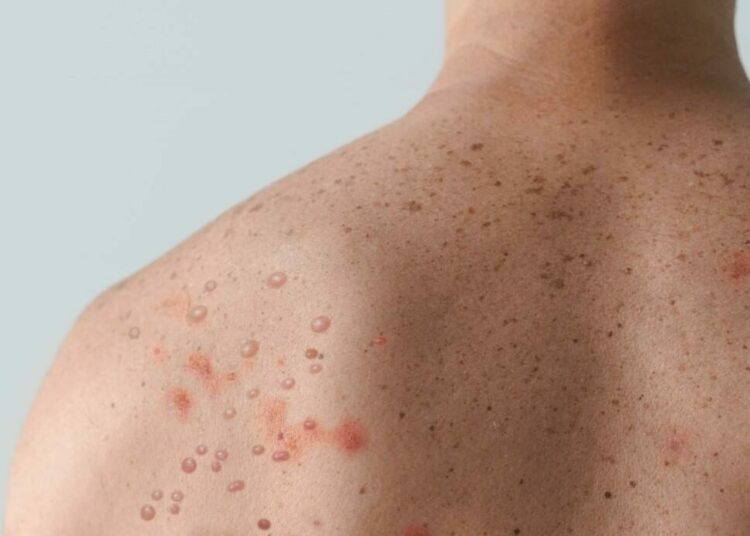 Orientation Agency Cautions Residents As Monkey Pox Hits 15 Akwa Ibom Councils 1 monkeypox lesions on back shoulder