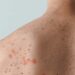 Orientation Agency Cautions Residents As Monkey Pox Hits 15 Akwa Ibom Councils 4 Orientation Agency Cautions Residents As Monkey Pox Hits 15 Akwa Ibom Councils