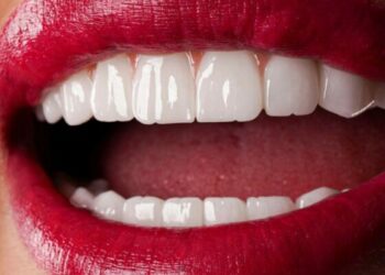 What Is A Hollywood Smile And Who Is It Best Suited For?