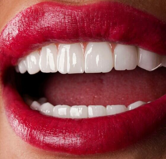 What Is A Hollywood Smile And Who Is It Best Suited For? 1 smile e1768227979207