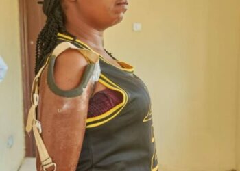 BSUTH Performs First Trans-Humeral Prosthesis, Restores Hope To Violence Survivor