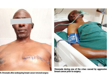 ‘I Thought It Was A Woman’s Disease’:  Male Breast Cancer Patient Narrates Ordeal