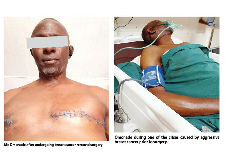 Male Breast Cancer Patient Narrates Ordeal