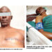 ‘I Thought It Was A Woman’s Disease’:  Male Breast Cancer Patient Narrates Ordeal