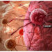 Tackling Nigeria’s Cancer Crisis Through Prevention, Equity