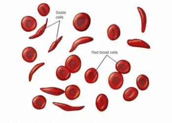 Is The Quest to Cure Sickle Cell in Nigeria Finally Yielding Results?