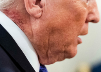 Trump Appears With Red Neck Rash At White House Event