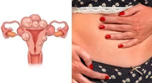 Gynaecologist Warns Uncontrolled Conditions Raise Fibroid Surgery Risks 1 FIBROD