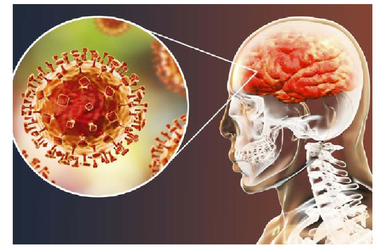 Meningitis