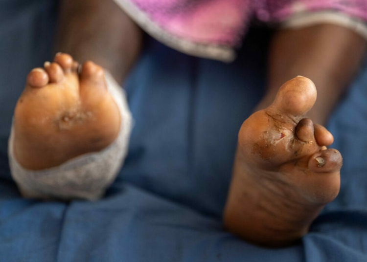 NGO Empowers Leprosy-affected Persons In Plateau 1 leprosy