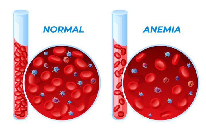 Preventing Maternal Anaemia For Healthier Mothers, Babies 1 Preventing Maternal Anaemia For Healthier Mothers Babies