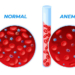 Preventing Maternal Anaemia For Healthier Mothers, Babies 5 Preventing Maternal Anaemia For Healthier Mothers, Babies
